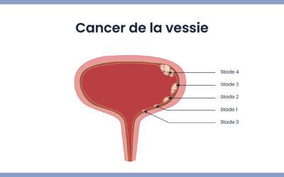 Avancées thérapeutiques dans le traitement du cancer de la vessie non infiltrant le muscle (TVNIM)